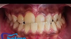 #crossbite#class 3 #invisalign #invisiblebraces #aligner #dentalbraces #reverse bite#braces
