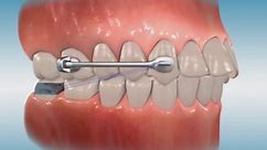 Cooke Orthodontics - Carriere® Motion™ Class II Appliance