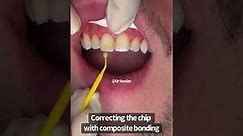 Fixing a chipped front tooth | composite bonding | Cosmetic Dentist Dr Yazdan