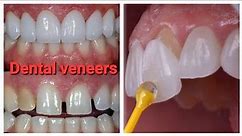 Dental Veneers|Teeth Veneers|Cosmatic Dentistry