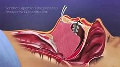 Obstructive Sleep Apnea Surgery... - Natural Hair Transplant