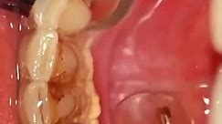 Removal of Tartar and Calculus from the teeth with Dental Cleaning Procedure. #fypシ゚viral #viraldentist #dentalcleaning🦷