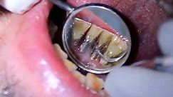 A sickle scaler for the removal of supragingival calculus | Extreme Dental Cleaning | stained teeth