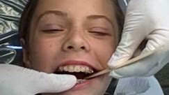 How A Herbst Appliance Is Placed, Manley Orthodontics