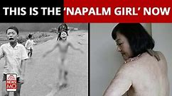 Vietnam war: After 50 years, ‘Napalm girl' in iconic Vietnam war photo gets final skin treatment in the US