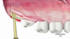 PIEZOSURGERY - ANIMATION - Upper tooth extraction Dr. Fabrizio Fontanella