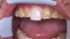 Houston Cosmetic Dentist...Step by step procedure for Porcelain Veneers...Conservative preps!