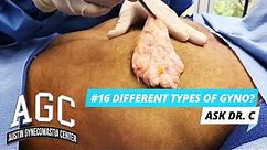 What Are The Different Types Of Gynecomastia? - Ask Dr. C - Episode 16