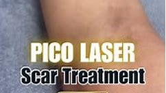 Scar... - Skin Haven Laser and Aesthetic Center - Pampanga
