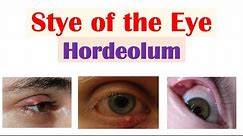 Eye Stye (Hordeolum) | Causes, Symptoms, Diagnosis & At Home Treatments