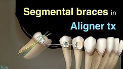 Using segmental braces to close large spaces in aligner treatment｜【Chris Chang Ortho】CC720