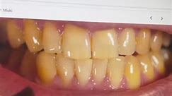 Get rid of em #foryou#yellowteeth#teeth#oralhealth#dentist#cavities#toothpaste
