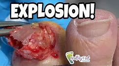BIG TOE READY TO EXPLODE! WATCH WHAT HAPPENS NEXT!