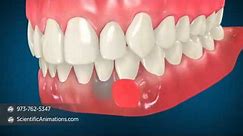 Gum Grafting Surgery - Dental Animation
