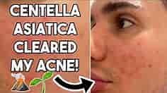 Centella Asiatica will CLEAR your ACNE! |🌱| Best products containing Centella!