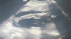 Reflections Of Mommy & Me 207 Westview Drive Villa Rica Ga, 30180 #maternityscan #3DUltrasound #4DUltrasound #BabyUltrasound #PregnancyScan #PrenatalImaging #UltrasoundImages #BabyBump #ExpectingParents #BondingWithBaby#UltrasoundTechnology #BabyOnTheWay #BabyLove #PregnancyJourney #MiracleOfLife #UltrasoundSession #PregnancyMoments #GlimpseOfBaby #MaternityScan #BabyReveal #BabyFace #ParenthoodPrep #PreciousMoments #UltrasoundArt #JoyOfPregnancy | Reflections of mommy & me
