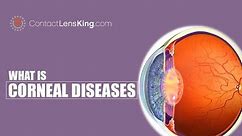 Corneal Diseases of the Eye | Keratoconus, Fuchs' Endothelial Dystrophy, Bullous Keratopathy