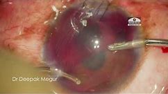 Corneo Scleral tear with iris prolapse & Hyphema in a One eyed patient . Principles of Surgery.