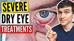 Severe Dry Eyes Treatment - Dry Eyes Treatment Guide