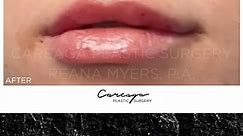 Lips that speak volumes! 💋💬 Our PA Reana Myers brings dreams to reality with her masterful lip filler techniques. Get ready to turn heads and embrace your newfound confidence ✨ - Call us at (305) 910-2702 or book your consultation online at the link in bio 📌 To be featured 📸: #careagaplasticsurgery @careagaplasticsurgery @careagamedspa | Careaga Plastic Surgery