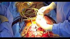 [Must Watch] Open Heart Surgery..!! (Live Heart Beating) Step-wise Procedure..!!♥️