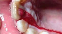 Drainage abscess through root canal