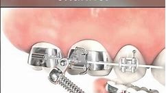 Forsus L Pin Module Fixed functional appliance #orthodontics #braces #dentist
