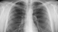 Chest x-ray - smoking. Animation of breathing chest and smoke coming inside.