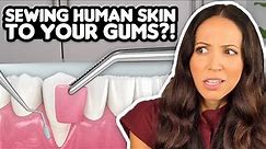 Gum Grafts Explained