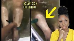 INSTANT Skin Bleaching Peel for Dark Skin!? Why I bleached my skin...