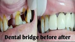 Fix dental bridge before and after