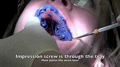 Dental Implant - Impression and Insertion of crown • Video • MEDtube.net