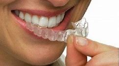 What Is Invisalign? Cost, Reviews, Before and After - Dentaly.org