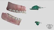 Removable Orthodontic Appliances: Types and Functions