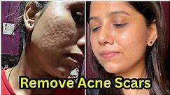 How to remove acne scars 😍 / Acne scars remove treatment / My skin transformation journey