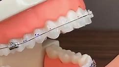 As an orthodontist, I would like to explain to you the uses of Class 2 elastics in your orthodontic treatment. Class 2 elastics, also known as rubber bands, are a common tool used to correct certain bite issues and improve your overall jaw alignment. Here are the main uses of Class 2 elastics: 1. Correcting Overbite: Class 2 elastics are often used to correct an overbite, which is when your upper front teeth protrude too far forward in relation to your lower front teeth. By attaching the elastic