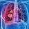 Advanced Lung Cancer