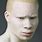 Albino Black Person