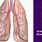 Asthmatic Bronchitis
