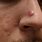 Big Nose Pimple