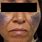 Black Skin Discoloration On Face