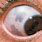Black Spot On EyeBall