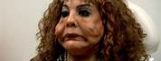 Botched Plastic Surgery Cement Injections