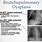 Bronchopulmonary Dysplasia Definition