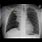 Chest X-Ray of Lung Cancer