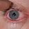 Corneal Abrasion Eye