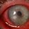 Corneal Eye Ulcer