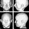 Craniofacial Abnormality