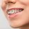 Dental Braces for Teeth