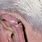 Ear Lobe Cancer